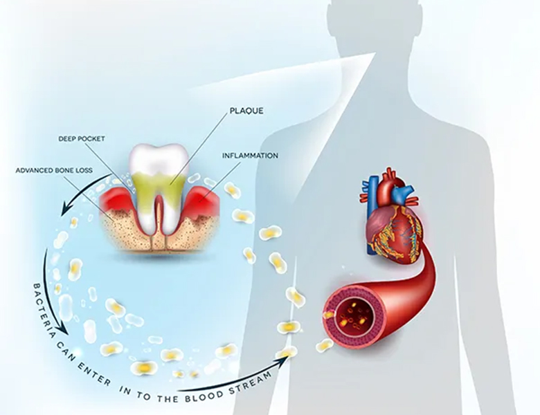 柏市・我孫子市の訪問歯科、すえいし歯科矯正歯科 歯科訪問部の歯周病治療