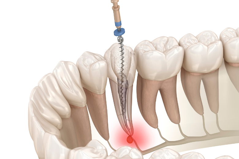 柏市・我孫子市の訪問歯科、すえいし歯科矯正歯科 歯科訪問部の根管治療