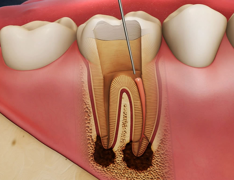 柏市・我孫子市の訪問歯科、すえいし歯科矯正歯科 歯科訪問部の根管治療