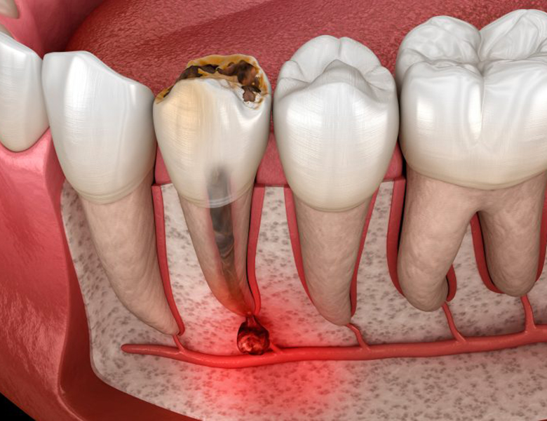 柏市・我孫子市の訪問歯科、すえいし歯科矯正歯科 歯科訪問部の根管治療