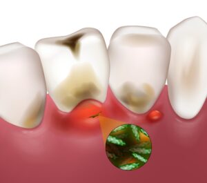 柏市・我孫子市の訪問歯科、すえいし歯科矯正歯科 歯科訪問部の誤嚥性肺炎の予防
